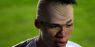 Lucas Tocantins passa por cirurgia na face e vira mais um desfalque na sequência da Série B Brasil-RS 1×1 Remo (Lucas Tocantins)